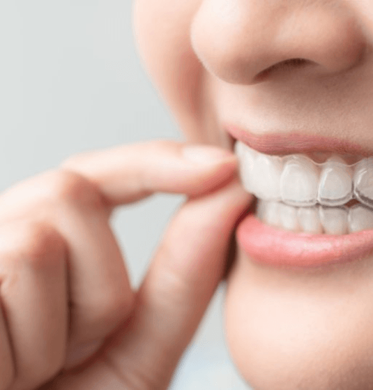 a woman putting on her custom-made clear aligners