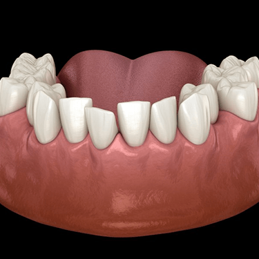 a 3D digital illustration of crowded teeth