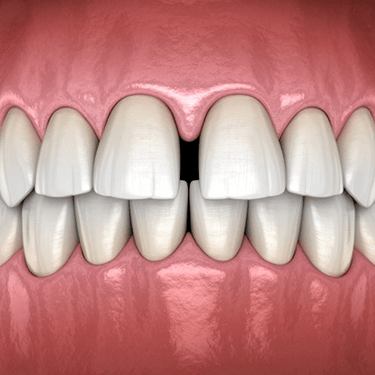 a 3D digital illustration of a gapped smile