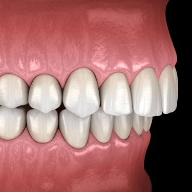 a 3D digital illustration of a bite misalignment