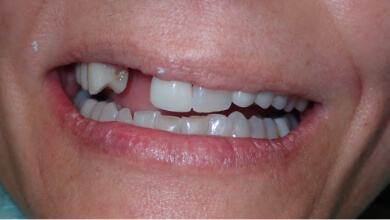 Close up of a mouth with a missing upper tooth