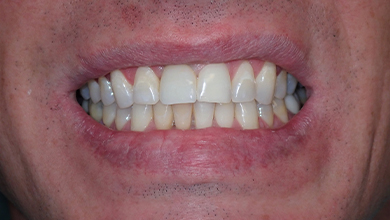 Close up of a man smiling after replacing his missing tooth