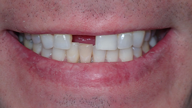 Close up of a man smiling with a missing tooth