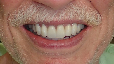 Close up of smile after treatment from Jacksonville dentist