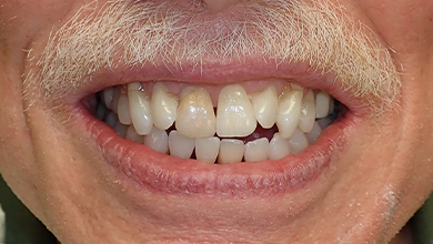Close up of smile with worn discolored teeth
