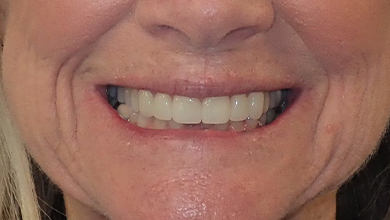 Close up of mouth after gapped teeth were fixed by Jacksonville dentist