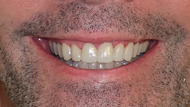 Close up of man smiling with evenly sized and spaced teeth