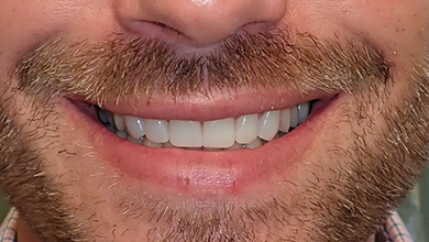Close up of mouth after cosmetic dental treatment