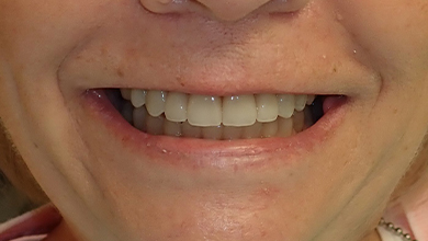 Close up of woman with a complete set of white teeth