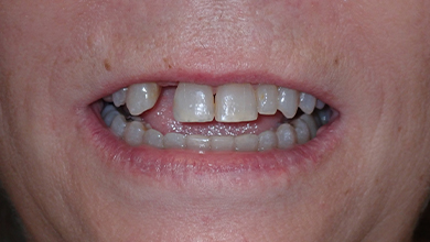 Close up of woman with a missing tooth and several stained teeth