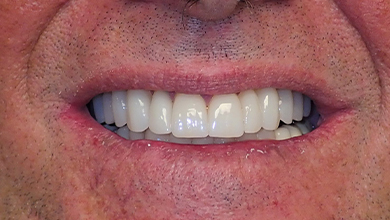 Close up of mouth with flawless teeth after dental treatment