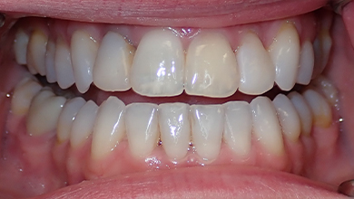 Close up of woman with slightly misshapen teeth