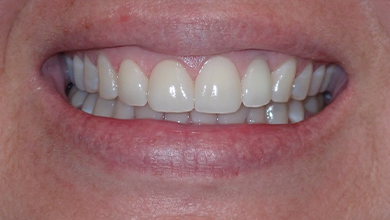 Close up of a smile with bright white teeth
