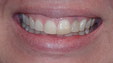 Close up of a smile with discolored teeth