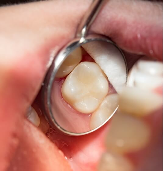 Close up of reflection of tooth in dental mirror