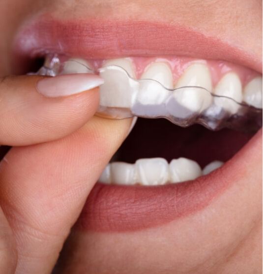 Close up of person placing an Invisalign clear aligner in their mouth