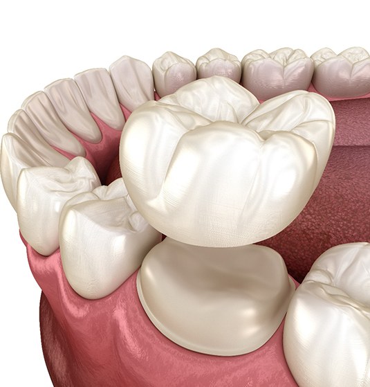 Dental crown in Jacksonville, FL being placed on tooth