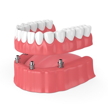 3D render of an implant denture