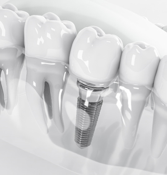 Illustration of dental implant in Jacksonville, FL in a plastic tray
