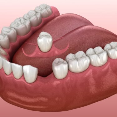 Animated partial denture replacing a missing tooth