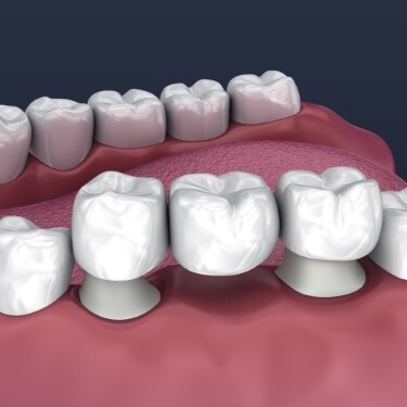 Animated dental bridge replacing a missing tooth