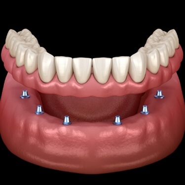 Six animated dental implants supporting a full implant denture