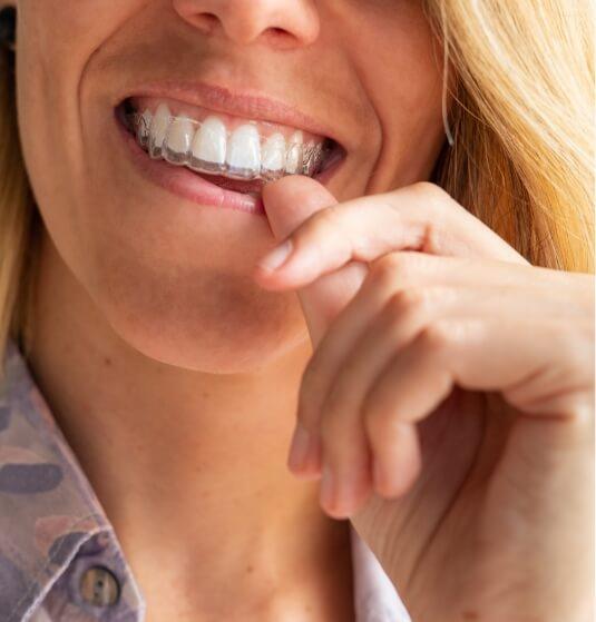 Blonde woman placing an Invisalign clear aligner in her mouth