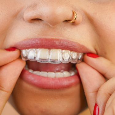 Be sure to wear your Altenbach Clear Aligners 22 hours a day