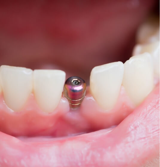 Close up of a smile with a dental implant