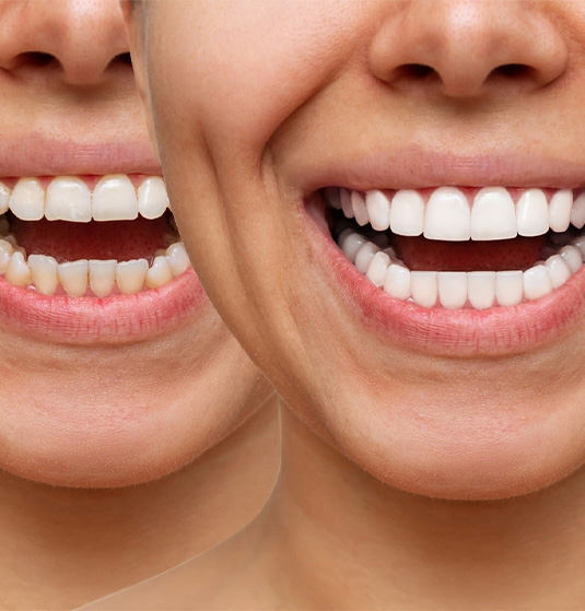 Close up of a person smiling before and after getting veneers in Jacksonville