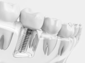 Model of a single dental implant