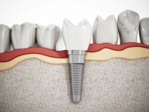 CGI image of a dental implant embedded in a lower arch