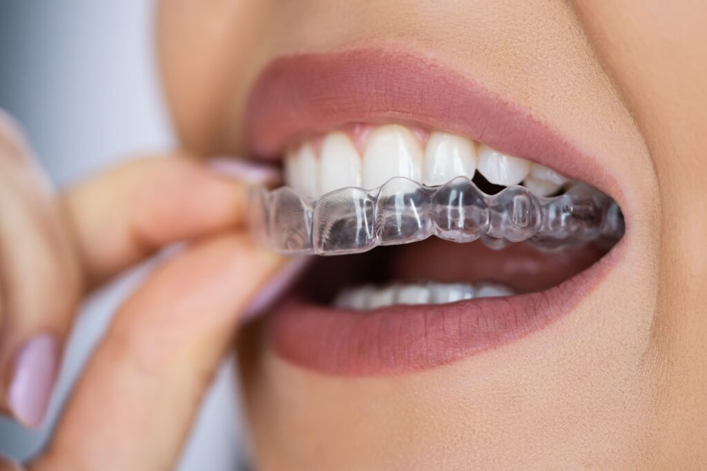 Closeup of woman inserting clear aligners over top teeth