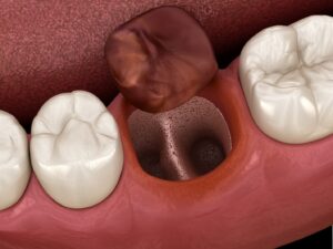 Discolored tooth out of its socket in digital rendering.